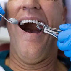 Dentysta używa kleszczy do ekstrakcji zęba, co może powodować ból po wyrwaniu zęba.