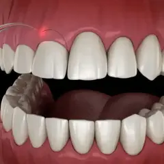 Zabieg gingiwektomii laserem. Precyzyjne cięcie dziąseł w celu poprawy estetyki uśmiechu.