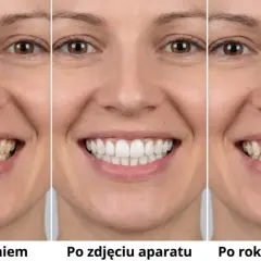 Przed i po leczeniu aparatem ortodontycznym. Widoczne efekty: zęby proste i białe po zdjęciu aparatu, a po roku bez retencji nadal zachowany piękny uśmiech.