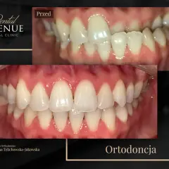 Aparat estetyczny przed i po: krzywe zęby wyprostowane, uśmiech odmieniony. Ortodoncja w Dental Avenue.