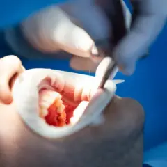 Co dentysta robi z wyrwanym zębem? Ważne informacje i procedury