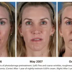 Retinol lek na co? Odkryj jego skuteczność w leczeniu skóry
