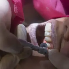 Dentysta usuwa resztki zęba w dziąśle po wyrwaniu.