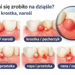 Ilustracja pokazuje różne stadia ropnia na dziąśle: guzek, krostkę, ropę i przetokę, ranę. Domowe sposoby mogą pomóc.