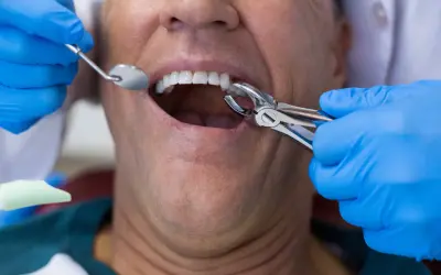 Dentysta używa kleszczy do ekstrakcji zęba, co może powodować ból po wyrwaniu zęba.