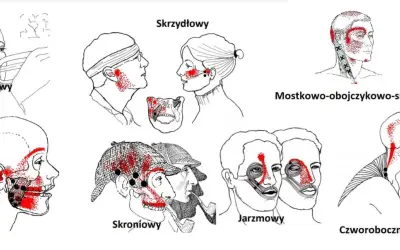 Ilustracje pokazują punkty bólu związane z urazem szczęki po uderzeniu w różne obszary twarzy i szyi.