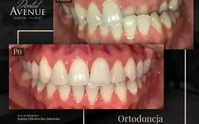 Aparat estetyczny przed i po: krzywe zęby wyprostowane, uśmiech odmieniony. Ortodoncja w Dental Avenue.