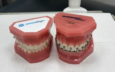 Dwa modele szczęk: jeden z przezroczystymi nakładkami Invisalign, drugi z tradycyjnym aparatem ortodontycznym.