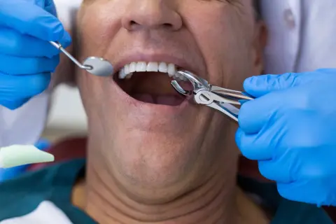 Dentysta używa kleszczy do ekstrakcji zęba, co może powodować ból po wyrwaniu zęba.