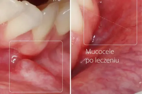 Zmiana na policzku: torbiel przed i po leczeniu. Widoczne zęby i błona śluzowa jamy ustnej.