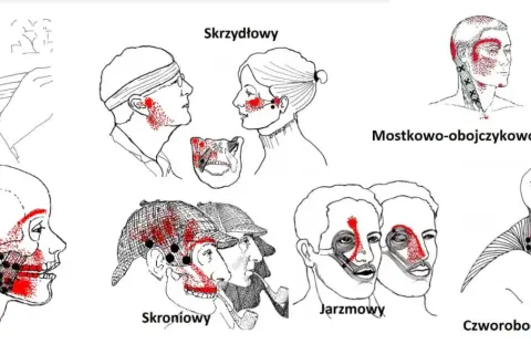 Ilustracje pokazują punkty bólu związane z urazem szczęki po uderzeniu w różne obszary twarzy i szyi.