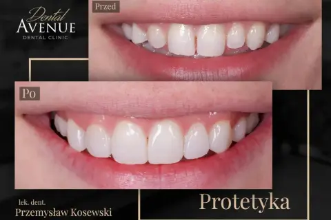 Przed i po: piękny uśmiech po zabiegu protetycznym. Bonding co to? To metoda poprawy estetyki zębów.
