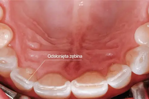 Widoczne odsłonięte szkliwo zębów, objaw bruksizmu. Leczenie może obejmować szyny relaksacyjne.