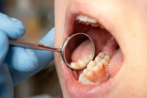 Dentysta bada zęby, szukając próchnicy między zębami. Widoczne są zęby trzonowe i lusterko stomatologiczne.