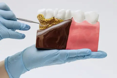Model szczęki z widocznym kamieniem nazębnym i chorobą dziąseł. Ręka w rękawiczce trzyma narzędzie dentystyczne.