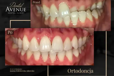 Aparat estetyczny przed i po: krzywe zęby wyprostowane, uśmiech odmieniony. Ortodoncja w Dental Avenue.