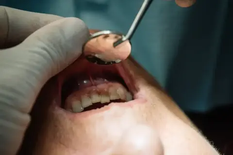 Dentysta bada jamę ustną, widoczne zęby i dziąsła. Może to być etap leczenia ropień zęba przebicie.