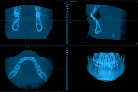 CBCT co to? Obraz przedstawia trójwymiarowe skanowanie szczęki i żuchwy, ukazujące zęby i kości w różnych przekrojach.