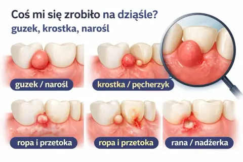 Czerwona kropka na dziąśle może oznaczać guzek, krostkę, narośl, ropień lub ranę. Ilustracje pokazują różne zmiany.