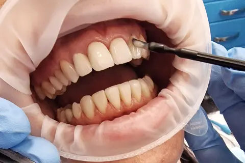 Zabieg lakierowania zębów w gabinecie stomatologicznym. Dentysta aplikuje preparat na zęby.