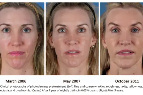 Retinol lek na co? Odkryj jego skuteczność w leczeniu skóry