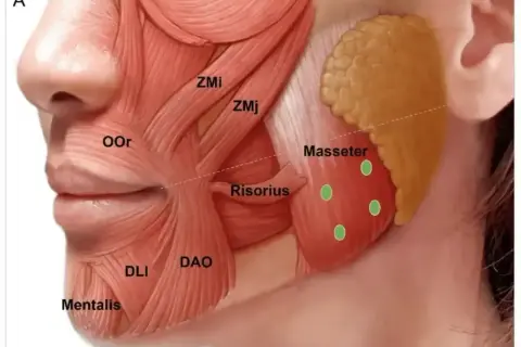 Anatomia mięśnia żwacza, z zaznaczonymi punktami iniekcji botoksu. Pomocne w leczeniu bruksizmu.