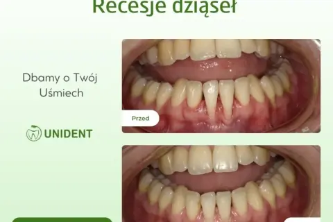 Przed i po leczeniu recesji dziąseł. Widoczne poprawa stanu dziąseł po zabiegu.