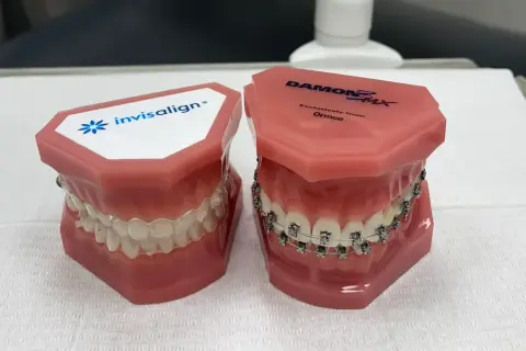 Dwa modele szczęk: jeden z przezroczystymi nakładkami Invisalign, drugi z tradycyjnym aparatem ortodontycznym.