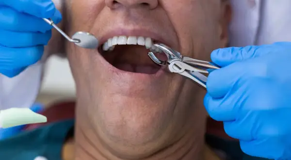 Dentysta używa kleszczy do ekstrakcji zęba, co może powodować ból po wyrwaniu zęba.