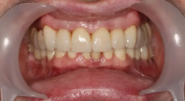 Uśmiech po leczeniu. Zdrowe dziąsła i zęby, to cel periodontologii. Co to jest? To dziedzina stomatologii zajmująca się leczeniem chorób przyzębia.