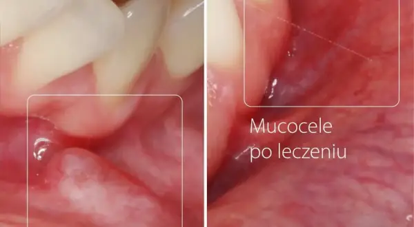 Zmiana na policzku: torbiel przed i po leczeniu. Widoczne zęby i błona śluzowa jamy ustnej.