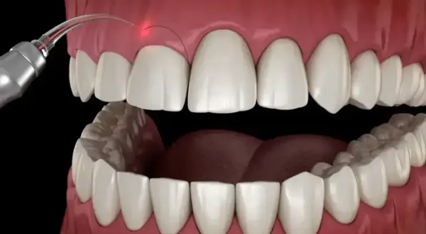 Zabieg gingiwektomii laserem. Precyzyjne cięcie dziąseł w celu poprawy estetyki uśmiechu.