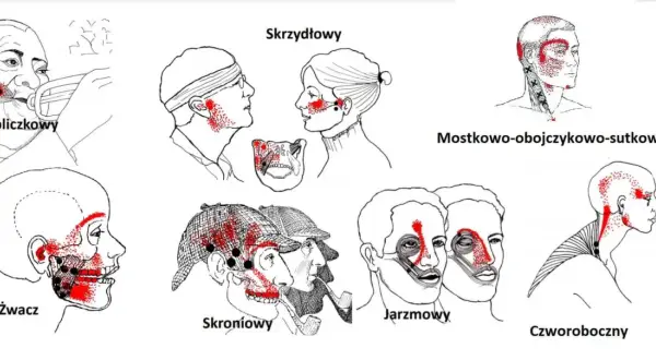 Ilustracje pokazują punkty bólu związane z urazem szczęki po uderzeniu w różne obszary twarzy i szyi.