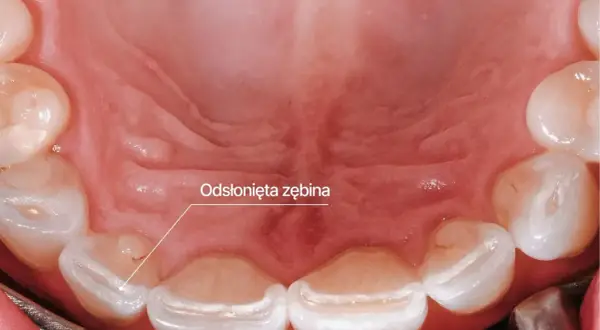 Widoczne odsłonięte szkliwo zębów, objaw bruksizmu. Leczenie może obejmować szyny relaksacyjne.