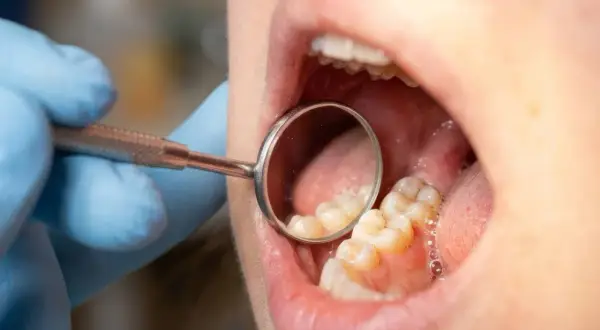 Dentysta bada zęby, szukając próchnicy między zębami. Widoczne są zęby trzonowe i lusterko stomatologiczne.
