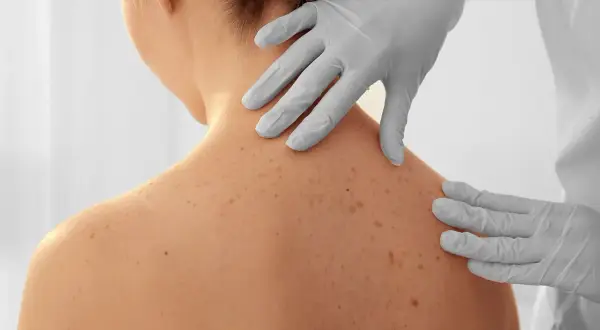 Dermatolog w rękawiczkach bada pieprzyki na plecach pacjentki.