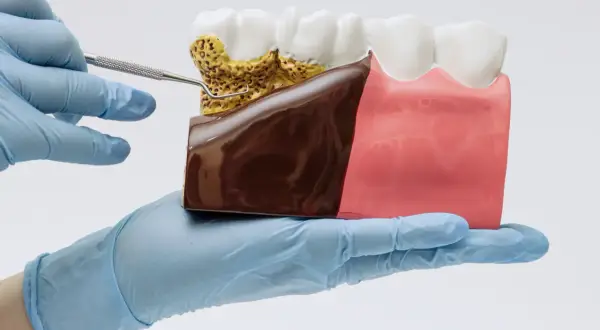 Model szczęki z widocznym kamieniem nazębnym i chorobą dziąseł. Ręka w rękawiczce trzyma narzędzie dentystyczne.
