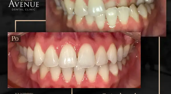 Aparat estetyczny przed i po: krzywe zęby wyprostowane, uśmiech odmieniony. Ortodoncja w Dental Avenue.