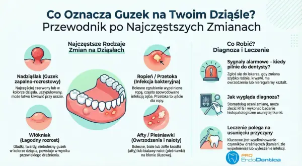 Guzek na dziąśle może być nadziąślakiem, włókniakiem lub ropniem. Warto skonsultować się z dentystą, gdy zmiana szybko rośnie.