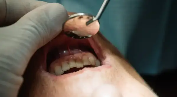 Dentysta bada jamę ustną, widoczne zęby i dziąsła. Może to być etap leczenia ropień zęba przebicie.