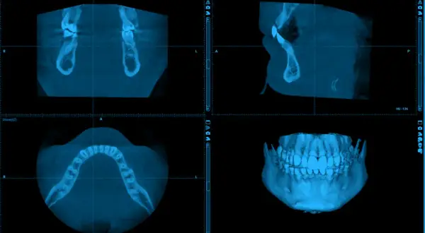 CBCT co to? Obraz przedstawia trójwymiarowe skanowanie szczęki i żuchwy, ukazujące zęby i kości w różnych przekrojach.