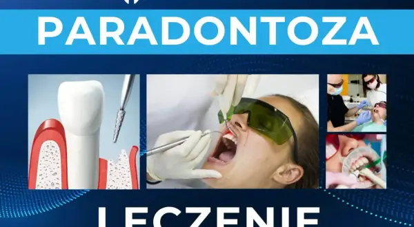 Leczenie paradontozy: ilustracja zęba z ubytkami kostnymi, zabieg laserowy i stomatologiczne procedury.