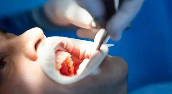 Co dentysta robi z wyrwanym zębem? Ważne informacje i procedury