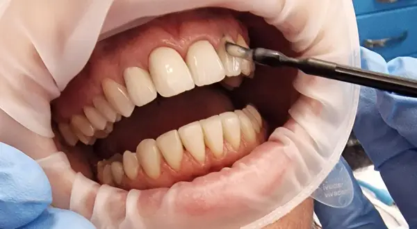 Zabieg lakierowania zębów w gabinecie stomatologicznym. Dentysta aplikuje preparat na zęby.