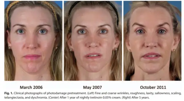 Retinol lek na co? Odkryj jego skuteczność w leczeniu skóry