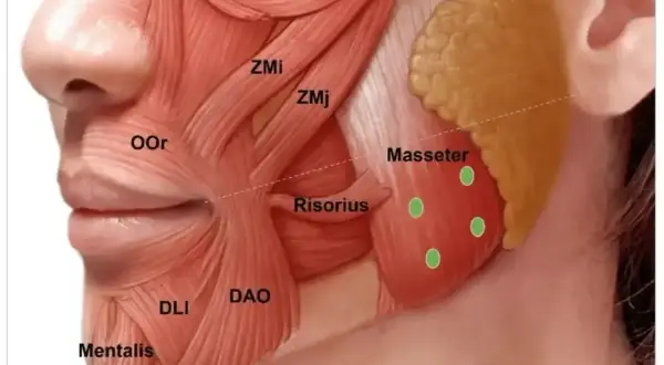 Anatomia mięśnia żwacza, z zaznaczonymi punktami iniekcji botoksu. Pomocne w leczeniu bruksizmu.