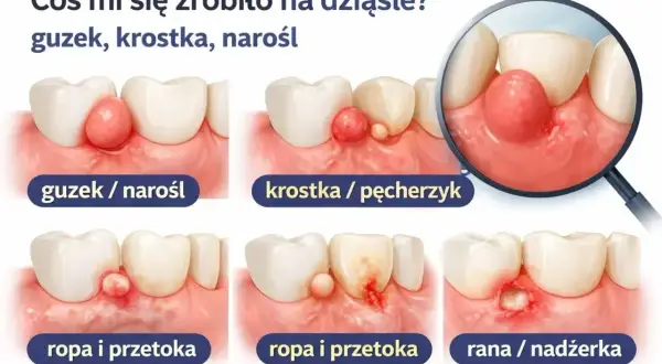 Ilustracja pokazuje różne zmiany na dziąśle: guzek, krostkę, ropę i przetokę, a także ranę. Krwiak na dziąśle może przybierać różne formy.