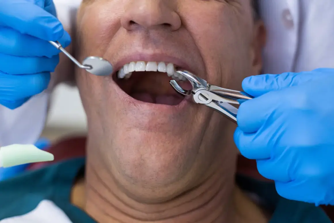 Dentysta używa kleszczy do ekstrakcji zęba, co może powodować ból po wyrwaniu zęba.