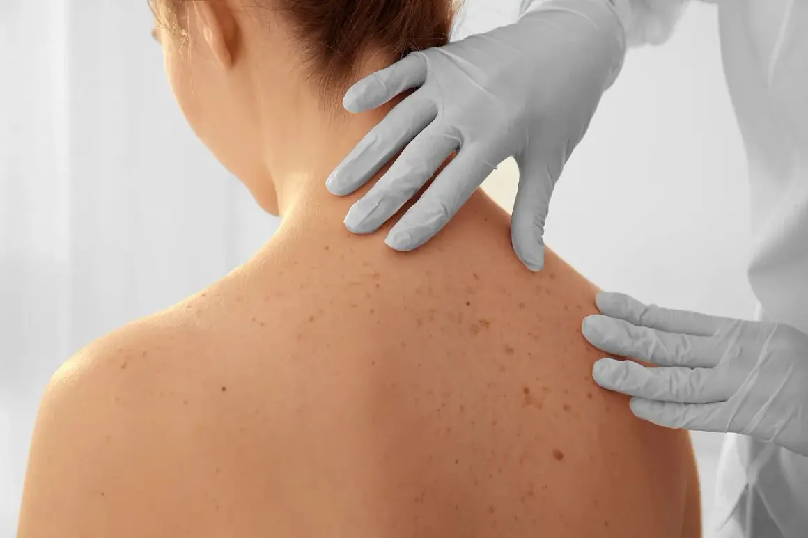 Dermatolog w rękawiczkach bada pieprzyki na plecach pacjentki.