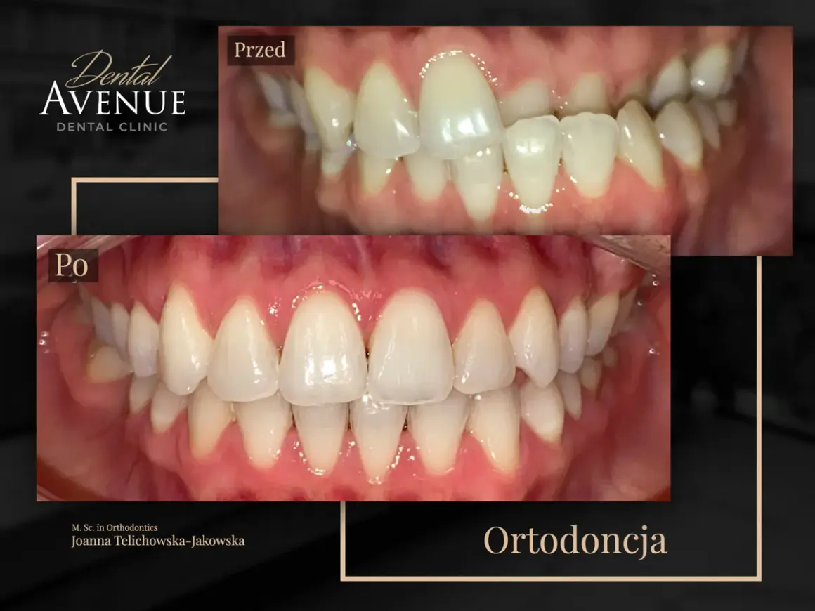Aparat estetyczny przed i po: krzywe zęby wyprostowane, uśmiech odmieniony. Ortodoncja w Dental Avenue.